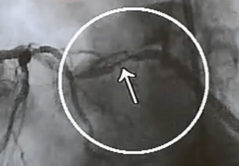 Angiographic Catheter 