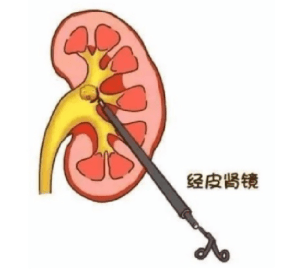 percutaneous renal expansion kit