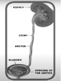  What Are the Application of Ureteral Stent?