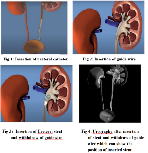 Ureteral stents